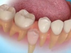 Есть ли у зубов способности к восстановлению?